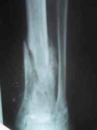 Image result for Osteomyelitis
