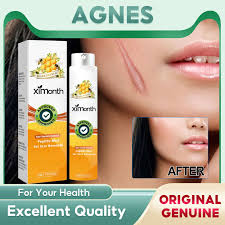 Ximonth Scar Removal Spray Stretch Mark Reduction Spray Efficacious Scar  Removal Spray Old Scars Eliminator Spray