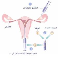 اطفال الانابيب عيادة الدكتور رائد خليفة