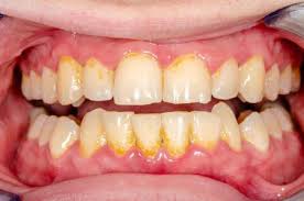 Brush regularly, twice a day for 2 minutes a time. Is Tartar Removal Painful Does It Damage The Enamel