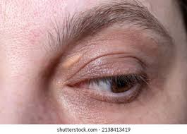 Image result for xantelasma