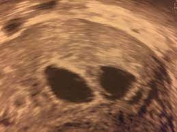 8 Ssw Dottersack Und Kein Embryo Schwangerschaftsgruppe Babycenter