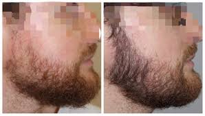 La greffe de barbe et de moustache est indiquée aux hommes qui sont imberbes, ont une barbe clairsemée ou souhaitent masquer une cicatrice. Barbe Et Moustache