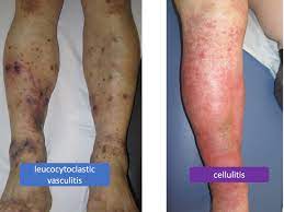 New Recommendations About Compression Therapy