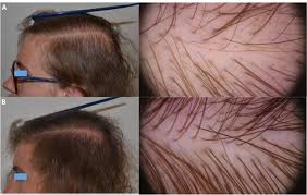 Dabei liegen haarwurzelschädigungen vor, die beispielsweise. Alopecia Areata Incognita And Diffuse Alopecia Areata Clinical Trichoscopic Histopathological And Therapeutic Features Of A 5 Year Study Dermatology Practical Conceptual