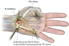 It lies in the same plane as the flexor digitorum profundus. Wiederherstellung Der Daumenendgelenkbeugung Durch Transposition Der Oberflachlichen Beugesehne Des Ringfingers Springerlink