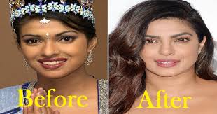 Bollywood Celebrities Who Got Plastic Surgery See Pics bollywood celebrities who got plastic