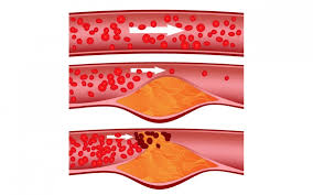 Zu welchem arzt soll ich mit einem blutgerinnsel gehen? Thrombose Blutgerinnsel Symptome Behandlung Vorbeugen Onmeda De