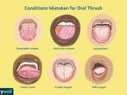When Your Tongue Turns White: Could It Be Thrush Or Something Else Entirely?