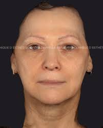 Avant ➝ Après ✨(agent de comblement) Un lifting subtil, sans excès. Chez  Clinique D, nous privilégions des résultats naturels, équilibrés et  élégants. Injection par Dre Danielle Brassard, dermatologue. 📍 Clinique D  📞