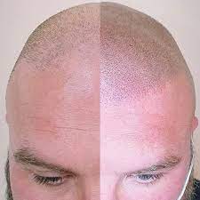 The scalp clinic - stafford | Stafford