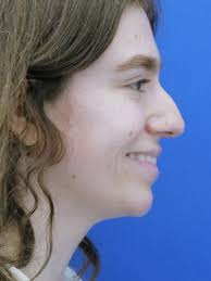 Dorsal Preservation and Narrow Base 6758