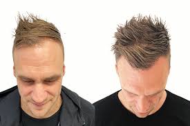 PRP og hårtransplantasjon før og etter bilder