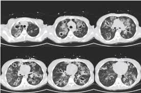 Early diagnosis and therapy significantly improve prognosis of patients with ia. Hemophagocytic Lymphohistiocytosis In A Patient With Influenza And Invasive Pulmonary Aspergillosis A Case Report