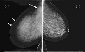 It is also an anatomic test, which means cancer is detected based on changes in how the breast anatomy looks. Inflammatory Breast Cancer Pet Ct Mri Mammography And Sonography Findings Springerlink
