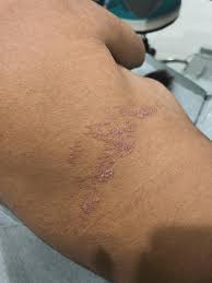 Image result for Linear Dermatitis