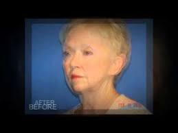 Facelift Ft Myers Face Lift Fort Myers Dr Audrey Farahmand Cosmetic Surgery In Cosmetics Plastic Surgeon Doctors