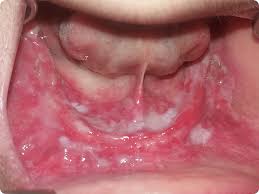 Image result for lichen planus on tongue)
