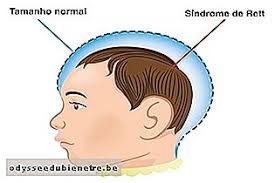 El diagnóstico generalmente se tiene en cuenta cuando se nota una disminución en el crecimiento de la cabeza o se producen pérdidas de habilidades. Come Riconoscere La Sindrome Di Rett It Odysseedubienetre Be