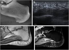 Key facts about the medial plantar muscles. Imaging Of Plantar Fascia Disorders Findings On Plain Radiography Ultrasound And Magnetic Resonance Imaging Abstract Europe Pmc