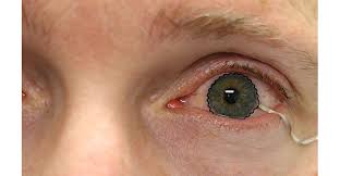Buy one get one free. Contact Lens Technology Enables Monitoring Of Medical Conditions Plasticstoday Com