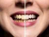 Jeder möchte, dass seine zähne weiß und schön sind. Zahne Bleichen Oder Aufhellen Beim Zahnarzt
