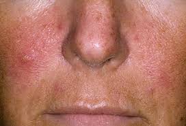 Image result for red rash face