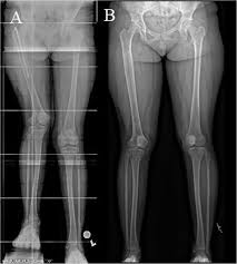 Image result for Functional Leg Length Discrepancy