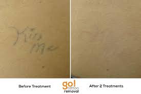 Simple Stick Poke Tattoos Are Typically Removed In 1 3 Treatments This One Is 95 Gone After 2 The Client Is Ha Tattoos Tattoo Removal Tattoo Removal Cost