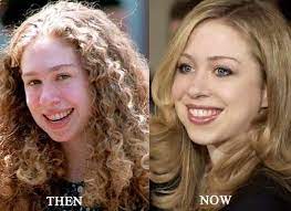 According to a medical doctor based in manhattan, dr walden, chelsea clinton apparently has got very well chin augmentation. Pin On Before After