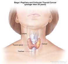 Neck swelling or a lump in the neck that may grow rapidly. General Surgery Thyroid Cancer
