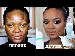 From Severe Acne To Clear Skin My Acne Skincare Routine Updated Acne Skincare Routine Severe Acne Skin Care Acne