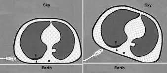 Click on the microphone icon and begin speaking axillary. Introduction To Lung Ultrasound Springerlink