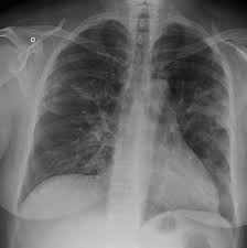 There is a degree of hyperinflation as evidenced by both increased retrosternal airspace and somewhat flattened and depressed diaphragms. H1n1 Influenza Radiology Reference Article Radiopaedia Org