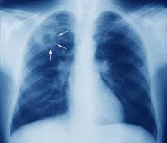 Segmental diagram of lung anatomy. Tuberculosis Tb Infectious Diseases Msd Manual Professional Edition