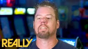 COLOCACIÓN DE MINI IMPLANTE EN SINFISIS MANDIBULAR