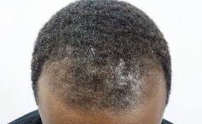 Discover the best hairstyles and most popular haircuts for men from classic to trendy. Bald Hair Care For Black Men Dapper Mane