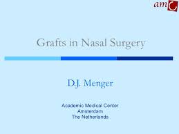 Before going ahead with nasal polyp removal, there may be other things you can try first, depending on your condition. Grafts In Nasal Surgery V1