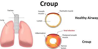 Image result for Croup