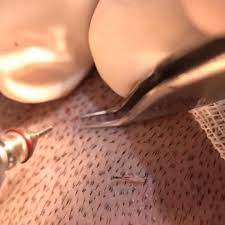 Thebarberpost Presents To You Hairofistanbul With Transplante Video Clip Trendi Beauty Standards Hair Transformation Mens Hairstyles
