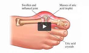 Maybe you would like to learn more about one of these? Mengenali Penyakit Kronis Pada Lansia Asam Urat Geriatri Id