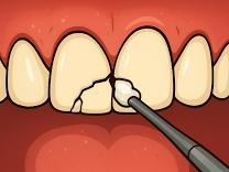 Composite Restorations product image