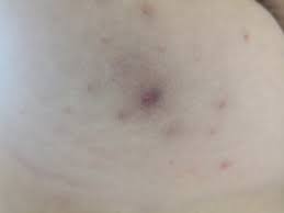 Was Tun Gegen Sehr Schlimme Hautunreinheiten Auf Der Brust Pickel Ausschlag Hautprobleme