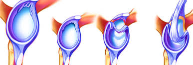 Image result for SLAP Lesion