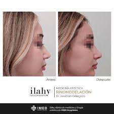 Cambios sutiles que lo son todo✨ Tratamiento realizado por el Dr. Jonathan  Orbegozo ¿qué os ha parecido?🤩 Recordad que podéis pedir vuestra cita con  el 👨🏻‍⚕️Dr. Orbegozo en nuestras clínicas de 📍Benidorm