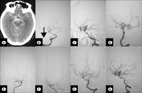 In addition to routine brain computed tomography (ct), ct angiography of the cervical and cerebral circulation can rapidly contribute valuable additional diagnostic information. Pre Operative Ct Scan And 6 Vessel Cerebral Angiogram A Ct Scan Download Scientific Diagram
