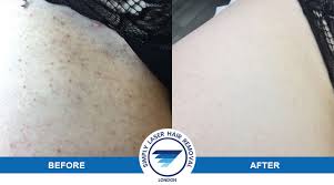 Or the hair grows sideways into the skin due to hardened, dead skin cells on the surface, according to jessica johnson, a completely bare brand ambassador. Laser Hair Removal For Ingrown Hairs