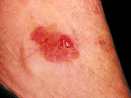 Whether you or someone you love has cancer, knowin. Squamous Cell Carcinoma Risks And Diagnosis