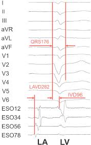 Cardiac Resynchronization Therapy Responder Surface Ecg I Ii Iii Download Scientific Diagram