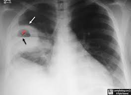 Image result for Lung Abscess
